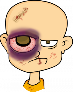 black-eye-proptosis.thumb.png.18840fb4cd49828a585891626c5d1f4b.png